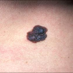 Example of skinCancerAndMelanomas